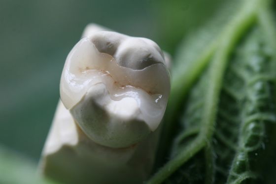 Naturalnie wyglądające wszystkie licówki porcelanowe EMAX Dental Crown
