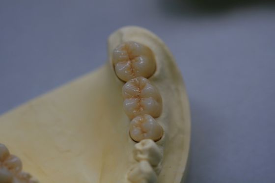 Laboratorium dentystyczne Korona dentystyczna z tlenku cyrkonu Porcelana z cyrkonu z ceramiką