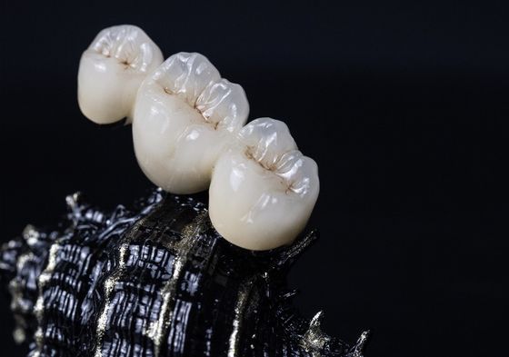 Korona dentystyczna podbudowy metalowej PFM