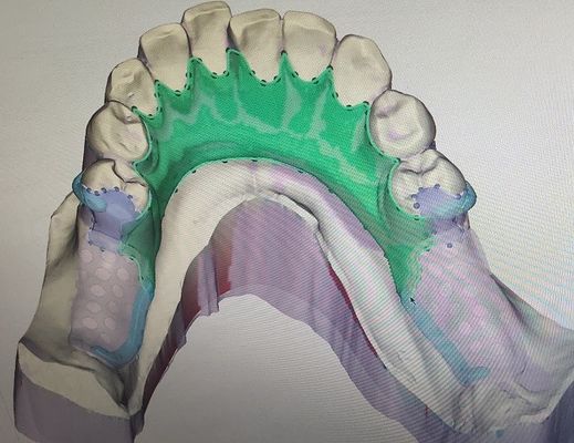 Zdejmowana metalowa konstrukcja protezy częściowej z nadrukiem 3D