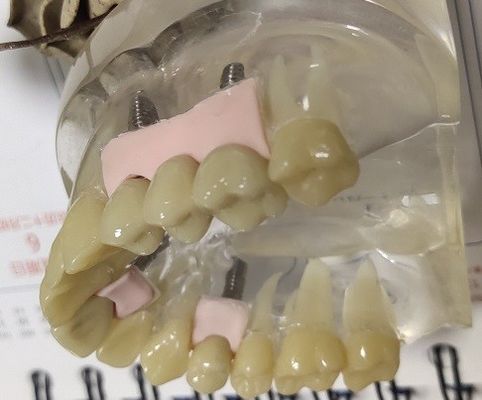 100-procentowa biokompatybilność tymczasowa korona z PMMA
