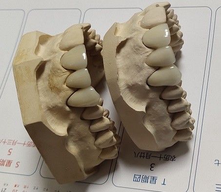 Korona porcelanowa CAD CAM PFM