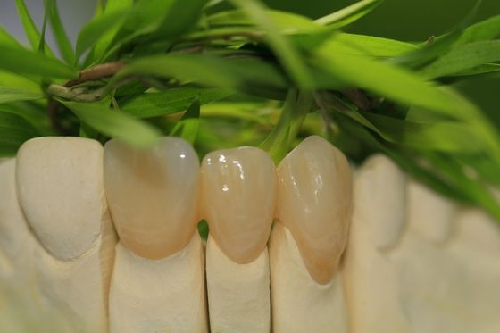 Stomatologia protetyczna Pełna korona z tlenku cyrkonu 5 gwiazdek Design Dental Lab