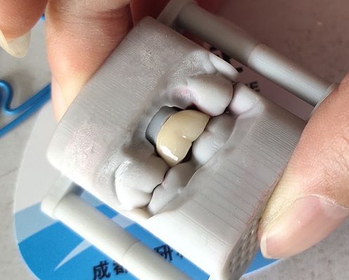 Laboratorium PFM Dental Crown Most do druku 3D Korona dentystyczna