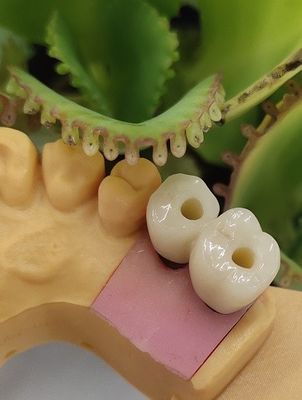 Cementowane rozwiązanie Korona implantów dentystycznych NOBEL BIOCARE